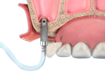 Синус-лифтинг биологический
