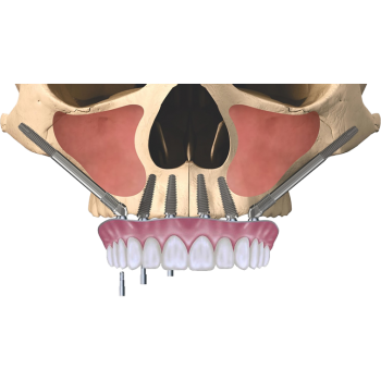 Скуловая имплантация Зигома