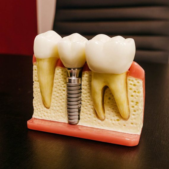 Материалы, из которых изготавливают импланты