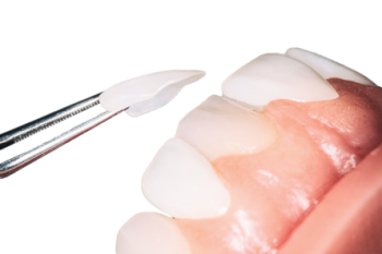 Виниры и люминиры